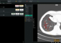 Coreline Smooth’s lung most cancers screening AI added to Bayer’s Calantic platform
