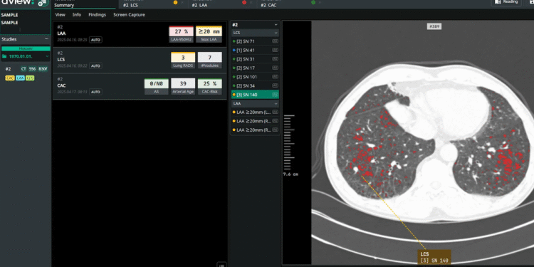 Coreline Smooth’s lung most cancers screening AI added to Bayer’s Calantic platform