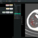Coreline Smooth’s lung most cancers screening AI added to Bayer’s Calantic platform