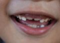 FDA strikes to ban fluoride dietary supplements for youths, eradicating a key software for dentists : Pictures