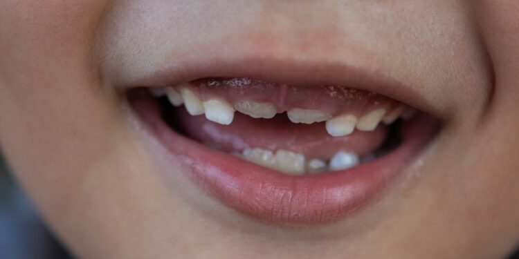 FDA strikes to ban fluoride dietary supplements for youths, eradicating a key software for dentists : Pictures