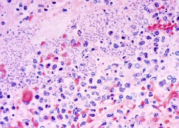 What to Know About Pneumonic Plague After Arizona Demise