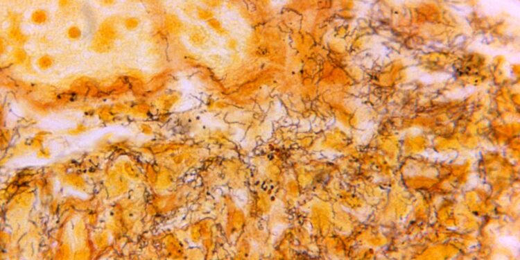 Why Syphilis Circumstances in Newborns Are Rising